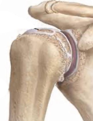 arthritis